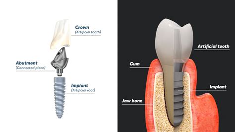 are there different quality dentla impants